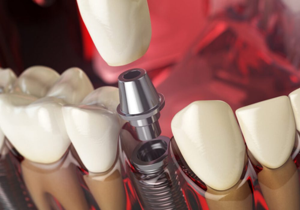 Dental Implants