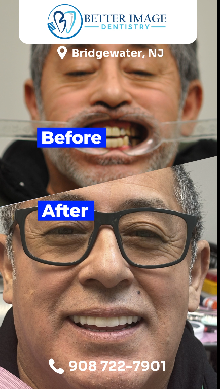 All-on-4 Patient Transformation