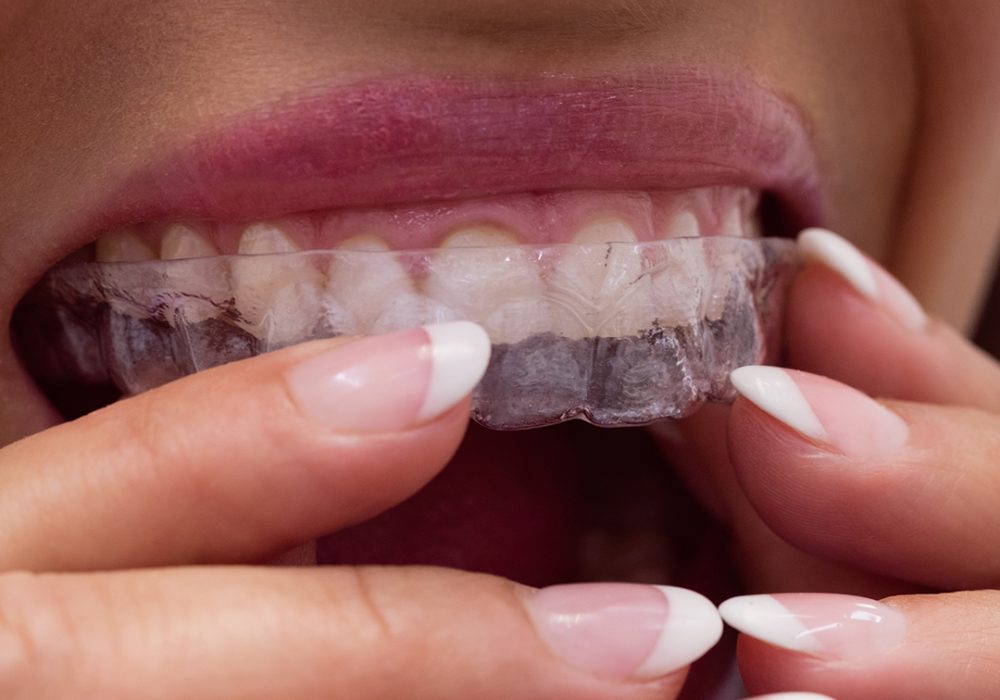 Invisalign