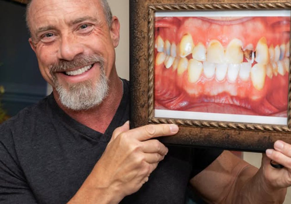 Smile Makeover